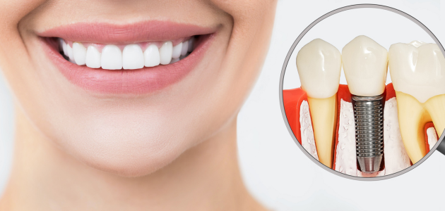 5. Implantes