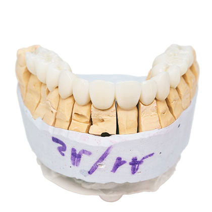Tratamiento Prótesis dentales en Clínica Microdental