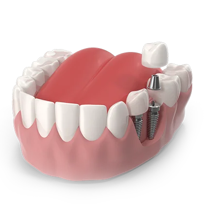 Tratamiento Implantología en Clínica Microdental