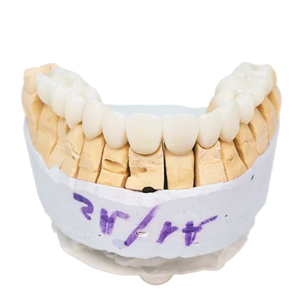Tratamiento Prótesis dentales en Clínica Microdental
